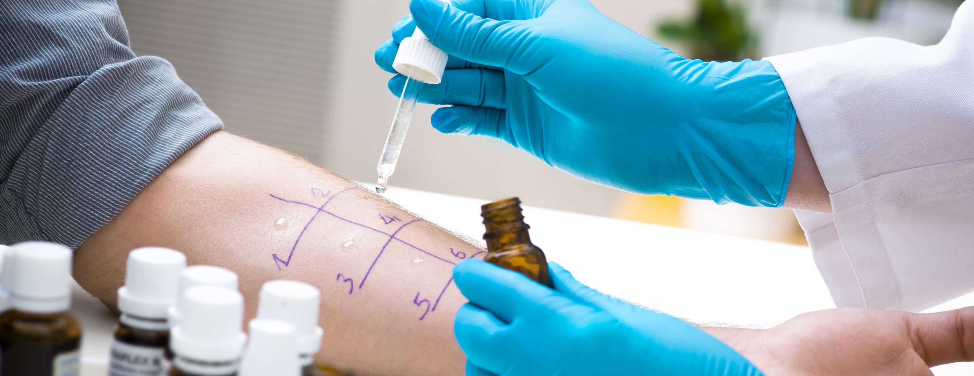 Allianz - Mit einem Prick-Test am Unterarm lassen sich Allergien erkennen